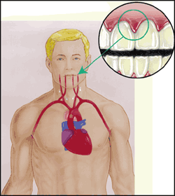 periodontal disease and heart disease