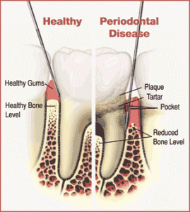healthy gums & bone vs. periodontal disease